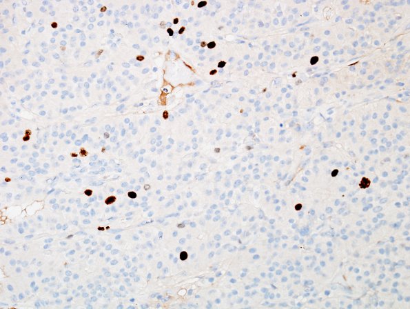 2G Paraganglioma (Case 2) MIB 1