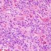 3A2 Paraganglioma (Case 3) H&E 1.jpg