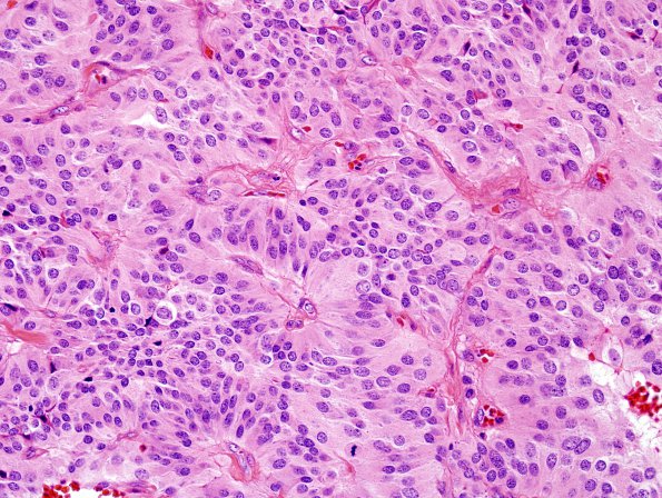 3A2 Paraganglioma (Case 3) H&E 1.jpg