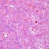 3A2 Paraganglioma (Case 3) H&E 2.jpg