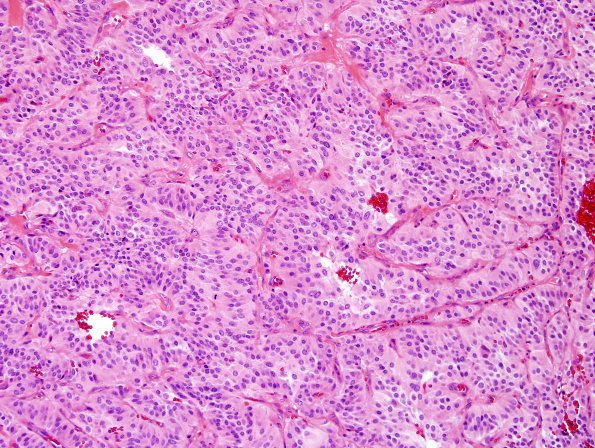 3A2 Paraganglioma (Case 3) H&E 2.jpg