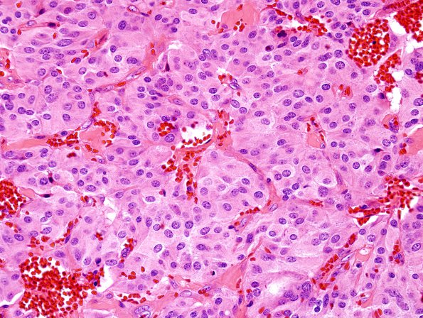 3A3 Paraganglioma (Case 3) H&E 4.jpg