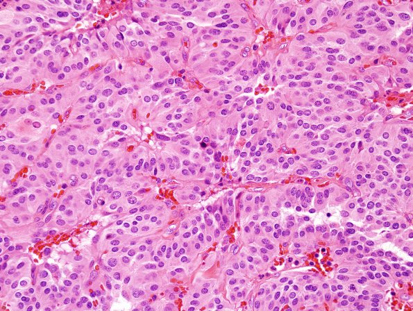 3A4 Paraganglioma (Case 3) H&E 6.jpg