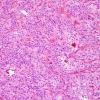 3A5 Paraganglioma (Case 3) H&E 7.jpg