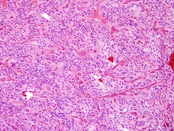 3A5 Paraganglioma (Case 3) H&E 7.jpg