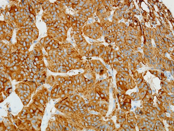 3B2 Paraganglioma (Case 3) SYN 1.jpg