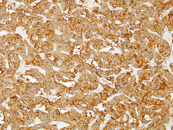 3B4 Paraganglioma (Case 3) SYN 7.jpg