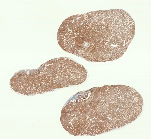3C1 Paraganglioma (Case 3) 1 Chr WM