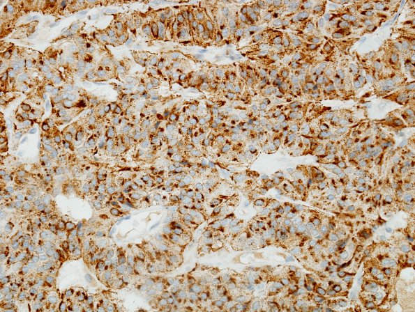 3C2 Paraganglioma (Case 3) Chr 1.jpg