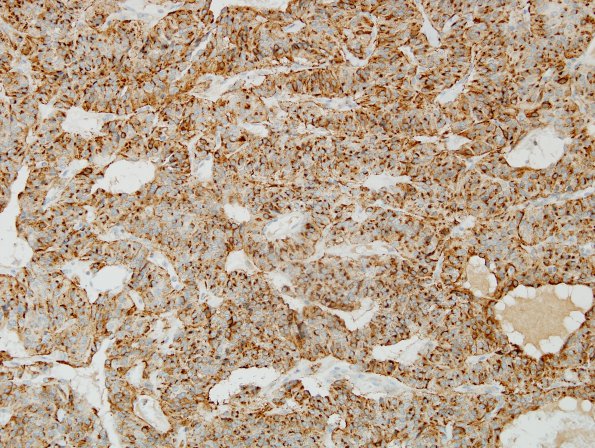 3C3 Paraganglioma (Case 3) Chr 3.jpg