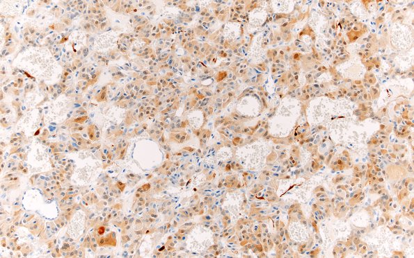 3D2 Paraganglioma (Case 3) 1 S100 10X