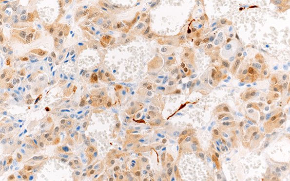 3D3 Paraganglioma (Case 3) 1 S100 40X