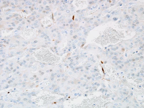 3D4 Paraganglioma (Case 3) S100 4.jpg