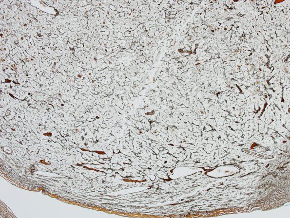 3E1 Paraganglioma (Case 3) Retic 1.jpg