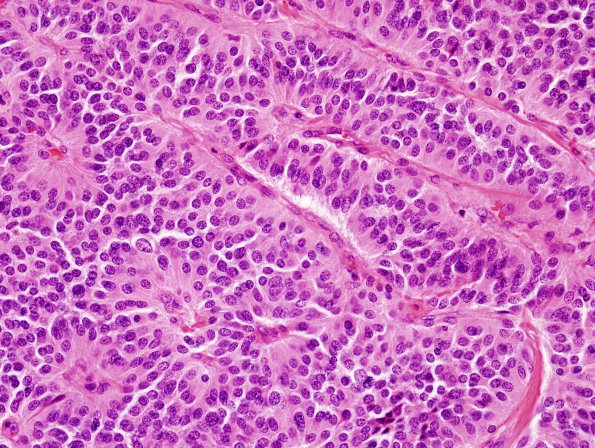 4A2 Paraganglioma (Case 4) H&E 4.jpg