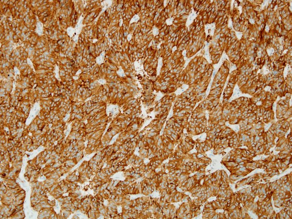 4B Paraganglioma (Case 4) SYN 1.jpg