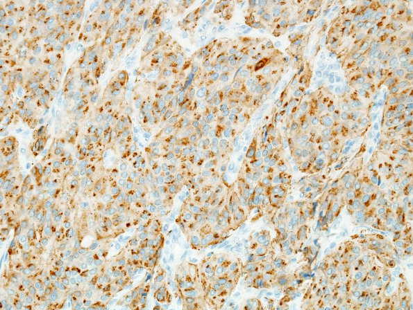 4C Paraganglioma (Case 4) Chrom 1.jpg