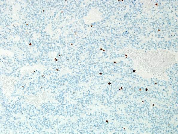 4F Paraganglioma (Case 4) Ki67.jpg