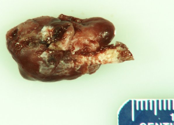 5A1 Paraganglioma (Case 5) Gross_2