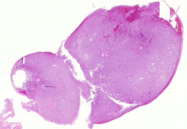 5B1 Paraganglioma (Case 5) 1 H&E WM