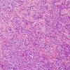 5B3 Paraganglioma (Case 5) H&E 3.jpg