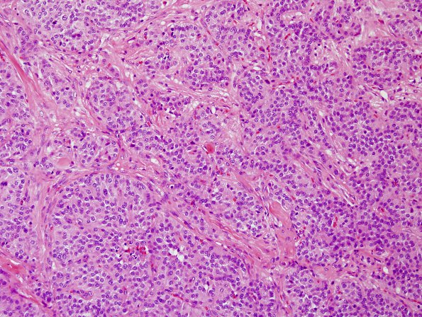 5B3 Paraganglioma (Case 5) H&E 3.jpg