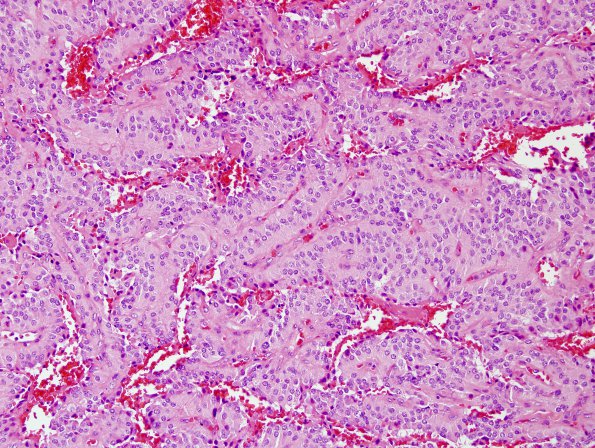 5B4 Paraganglioma (Case 5) H&E 6.jpg