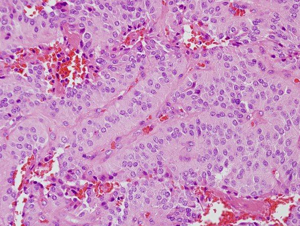 5B5 Paraganglioma (Case 5) H&E 7.jpg