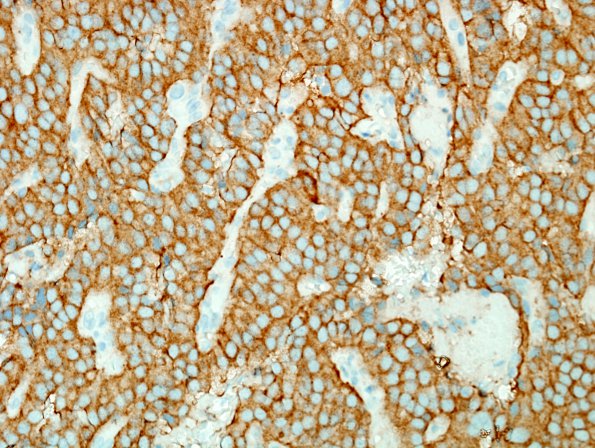 5C1 Paraganglioma (Case 5) SYN 1.jpg