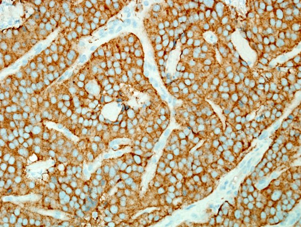 5C2 Paraganglioma ((Case 5) SYN 2.jpg