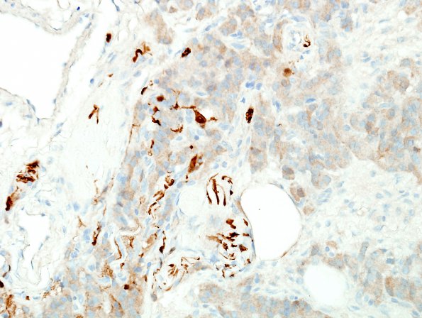 5E2 Paraganglioma (Case 5) S100 8.jpg