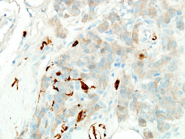 5E3 Paraganglioma (Case 5) S100 7.jpg