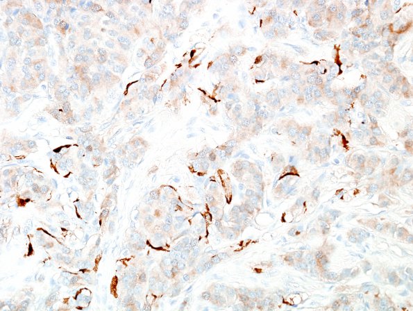 5E5 Paraganglioma (Case 5) S100 11.jpg