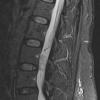 6A1 Paraganglioma (Case 6) STIR - Copy