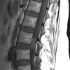 6A2 Paraganglioma (Case 6) T1 no C - Copy