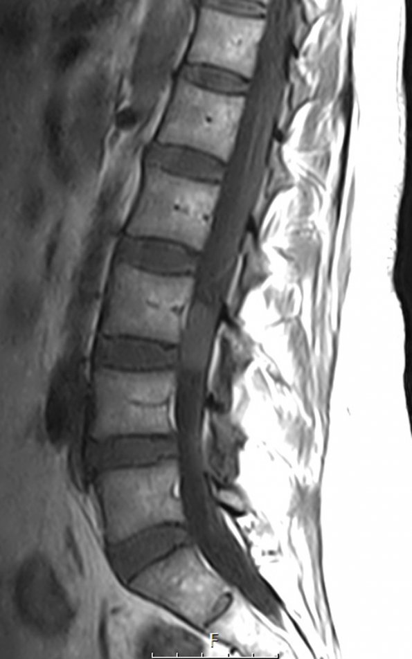 6A2 Paraganglioma (Case 6) T1 no C - Copy