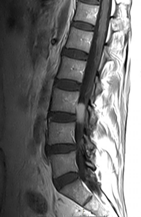 6A3 Paraganglioma (Case 6) T1 with C - Copy