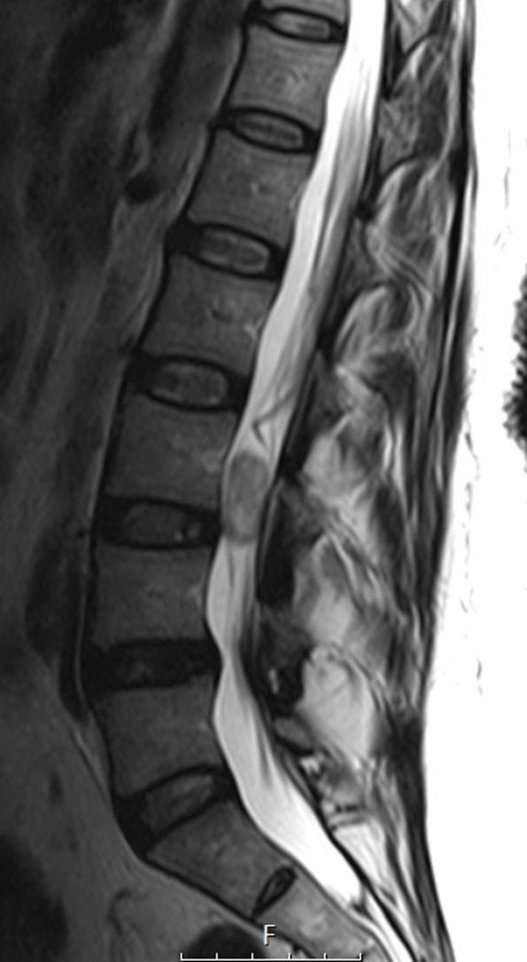 6A4 Paraganglioma (Case 6) T2 no C - Copy