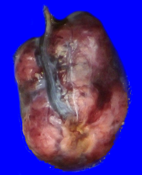 6B1 Paraganglioma (Case 6)_1