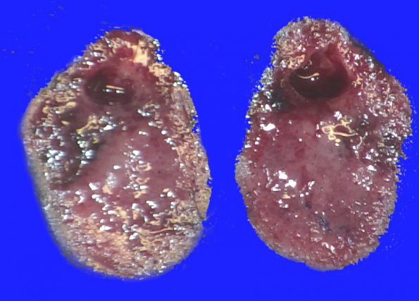 6B2 Paraganglioma (Case 6)_2