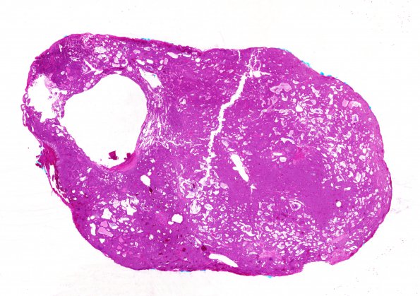 6C1 Paraganglioma (Case 6) H&E WM