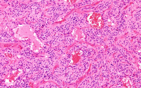 6C2 Paraganglioma (Case 6) H&E 1