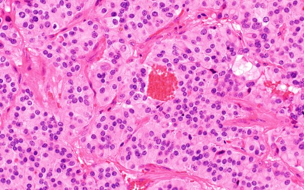 6C3 Paraganglioma (Case 6) H&E 2