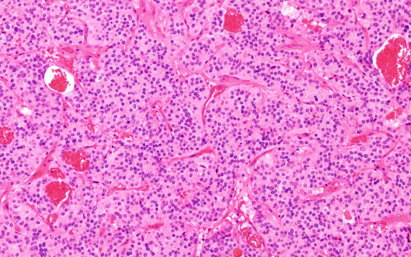 6C4 Paraganglioma (Case 6) H&E 3