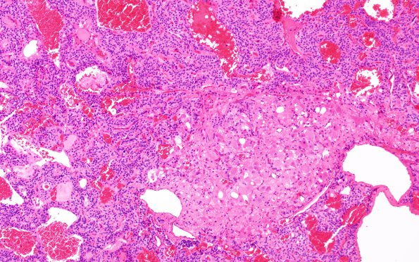 6C5 Paraganglioma (Case 6) H&E 5 (ganglionic diffn)