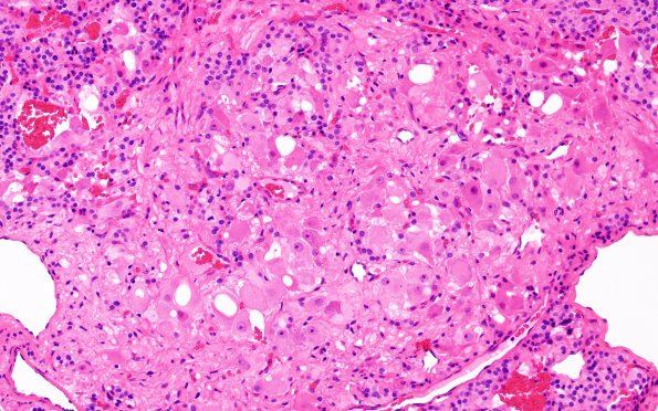 6C6 Paraganglioma (Case 6) H&E 4 (ganglionic diffn)