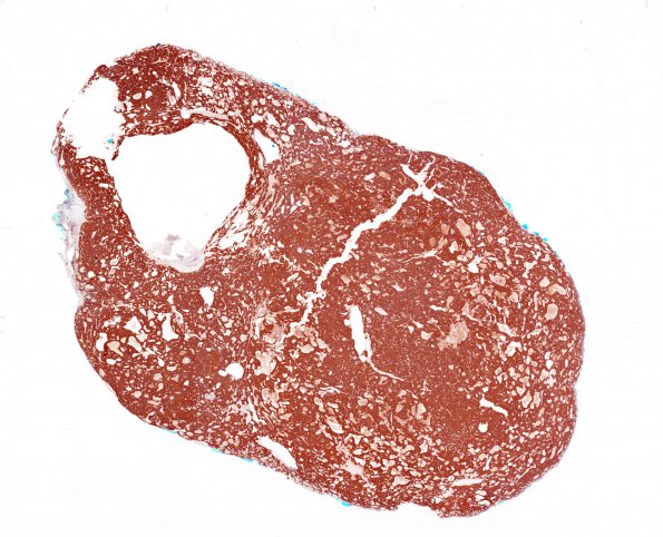 6D1 Paraganglioma (Case 6) Synaptophysin whole mount