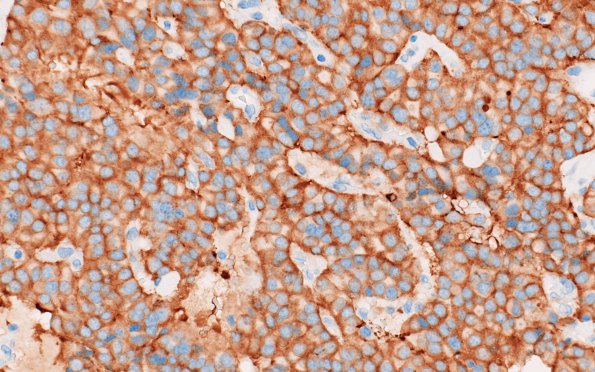 6D3 Paraganglioma (Case 6) SYN 1