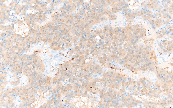 6E1 Paraganglioma (Case 6) S100 20X 2