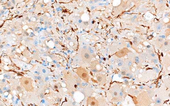 6E3 Paraganglioma (Case 6) S100 40X